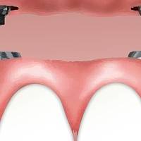 Разнообразие от базални импланти 5 от MedicalDent Разнообразие от базални импланти 5