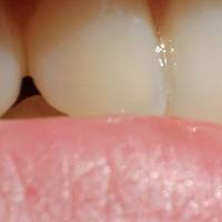 Типове базални импланти 6 от MedicalDent Типове базални импланти 6