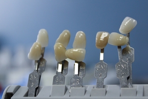 Разнообразие от зъбни импланти 29