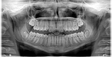 Ефектни зъбни импланти 30