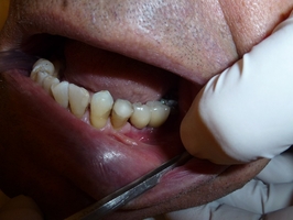 Information about Dental Implants 10