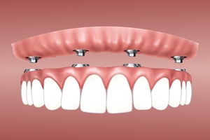 Find Dental Implants 33