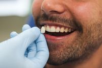 избелване на зъби - 99187 комбинации