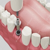 зъбни импланти - 21064 разновидности