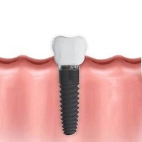 зъбни импланти - 16844 разновидности