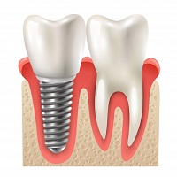 зъбни импланти - 13718 варианти