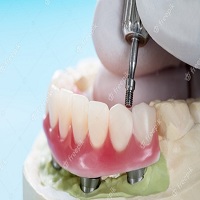 зъбни импланти - 27976 награди